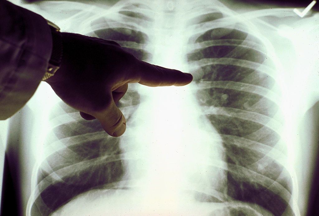 الأشعة السينية تكشف الأضرار التي يسبّبها ”كورونا“ في الرئتين
