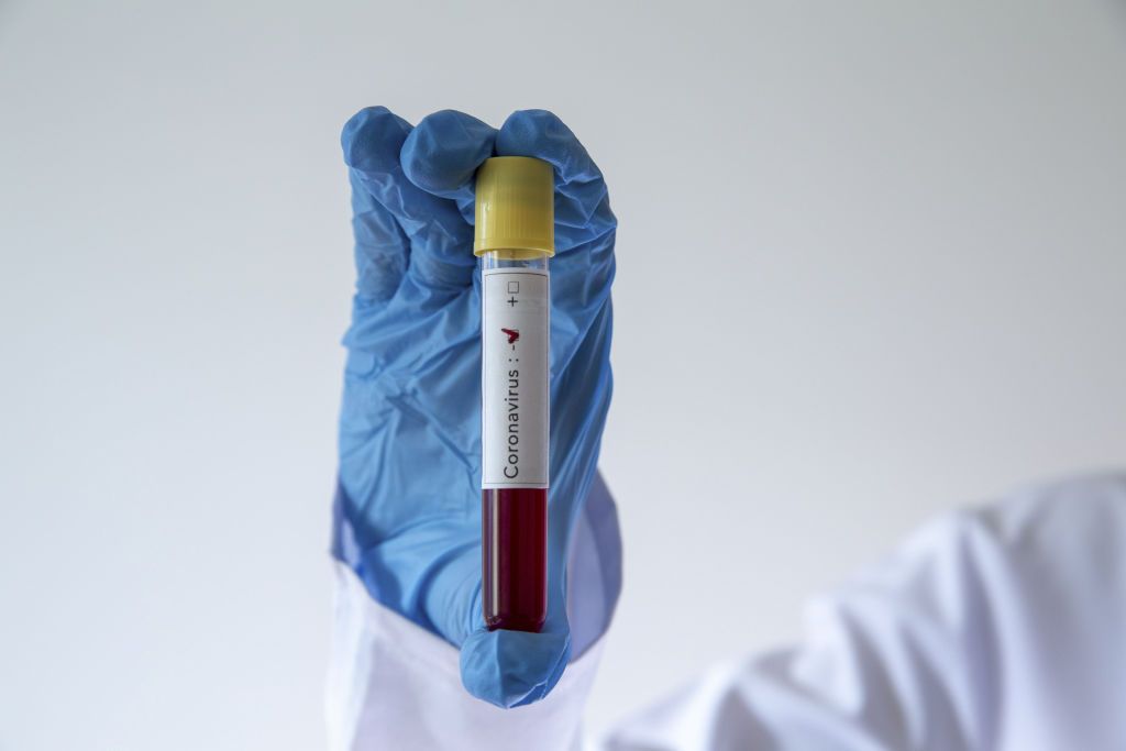 هولندا: تجربة جديدة لكشف ”كورونا“ من خلال اختبارات الدم