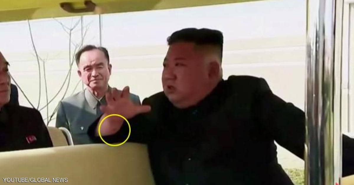 “معصم” كيم.. هل يفسر سبب اختفاء زعيم كوريا الشمالية؟