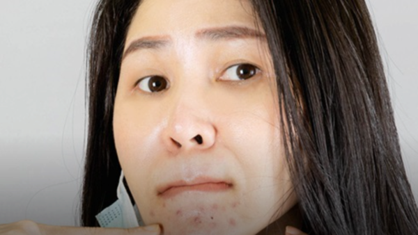 7 نصائح لتجنب مشكلات الوجه والبشرة بسبب الكمامات