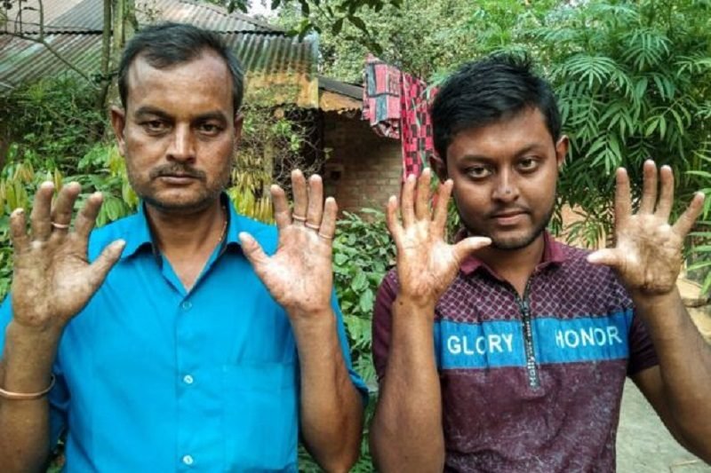 عائلة بدون بصمات الأصابع في بنغلاديش