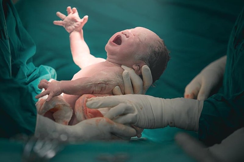 فريق طبي يخرج جنينا من بطن طفلة عمرها 7 أيام