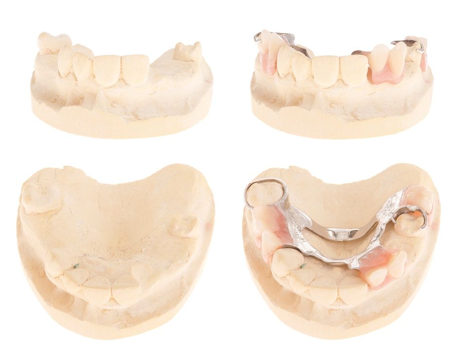 دراسة حديثة تكشف تأثير فقدان الأسنان على الصحة العقلية
