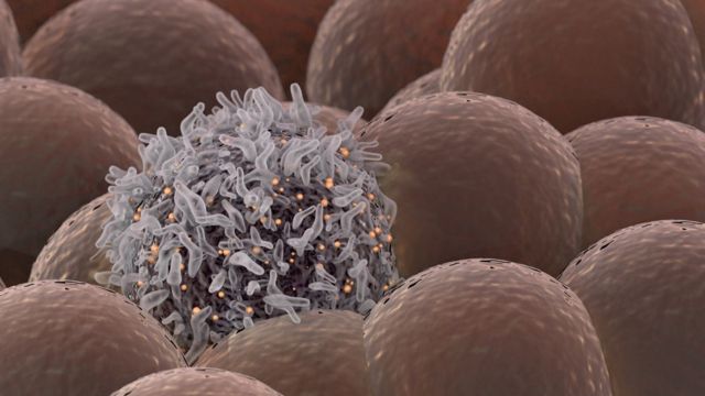 سرطان الثدي غير القابل للشفاء: دراسة تكشف عن أدوية جينية تطيل عمر المصابات به